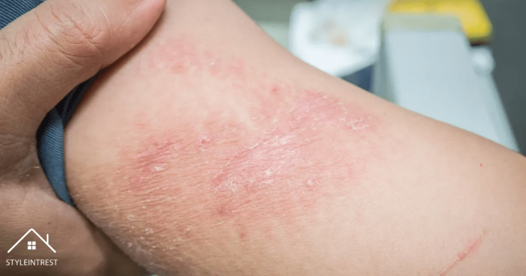 Allergic Contact Dermatitis 