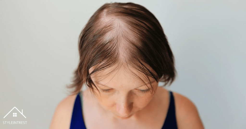 Alopecia Areata