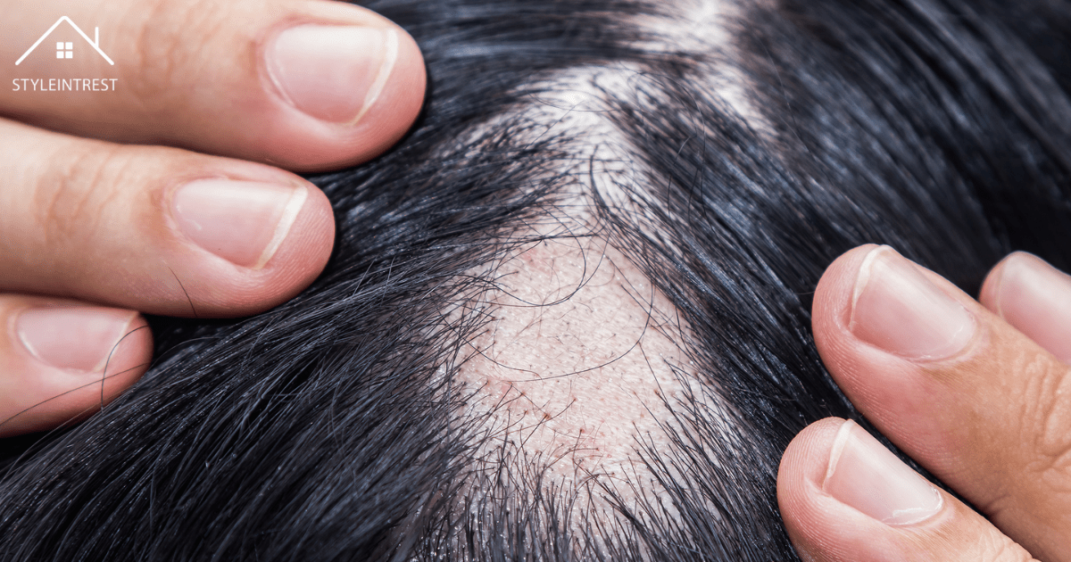 Can Allergies Cause Hair Loss