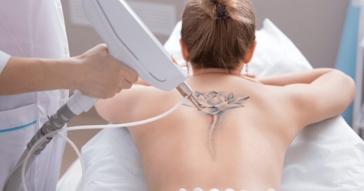 Can You Get Laser Hair Removal Over a Tattoo?