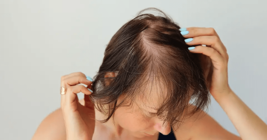  Hair loss or thinning