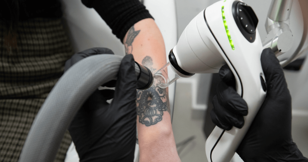 Understanding the Compatibility of Laser Hair Removal and Tattoos