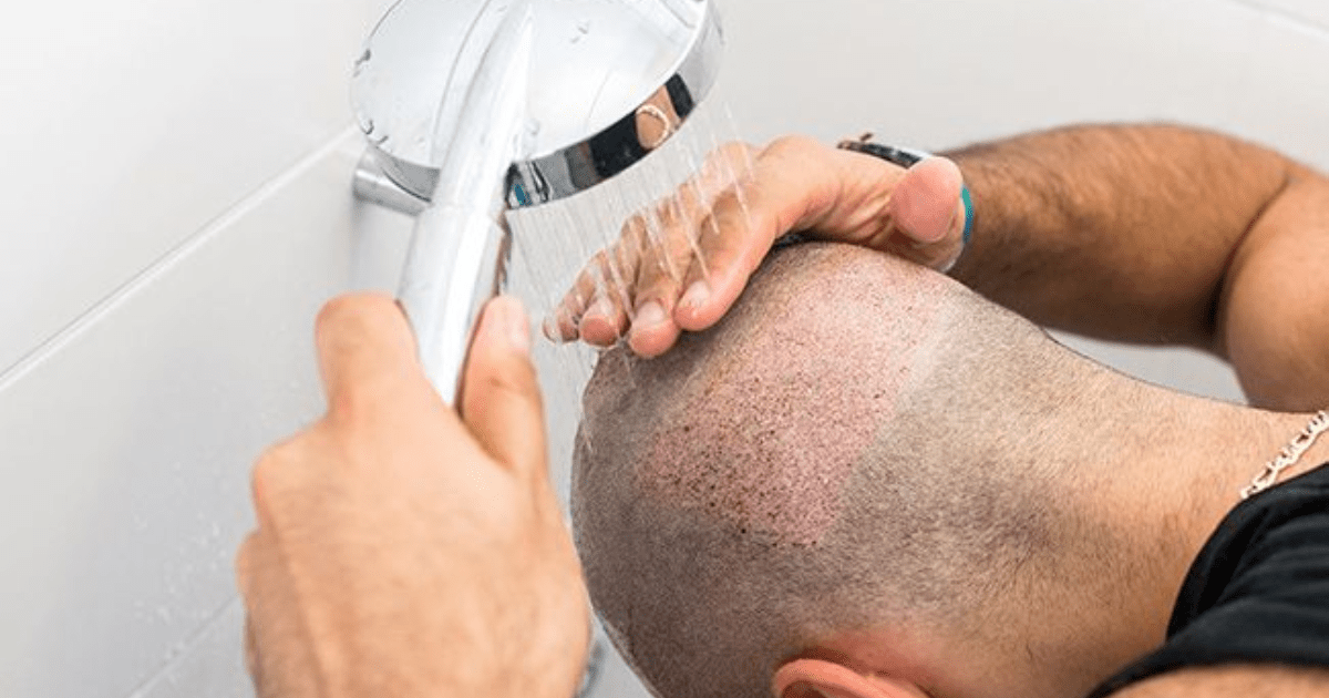  When Can I Wash My Hair Normally After Hair Transplant?