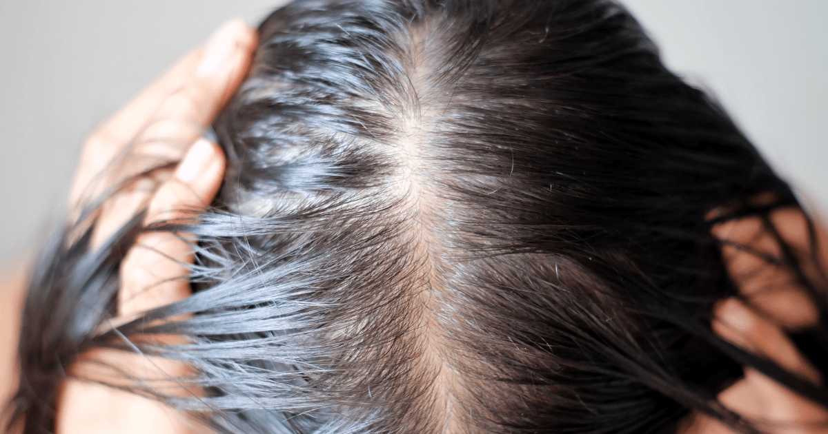 Why Can I See My Scalp Through My Hair?