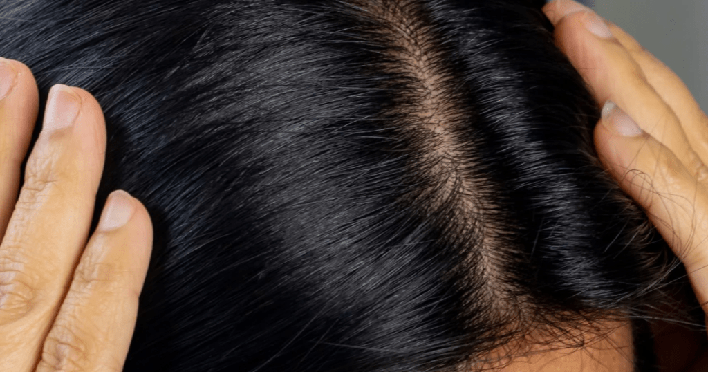 Why Can I See My Scalp Through My Hair?