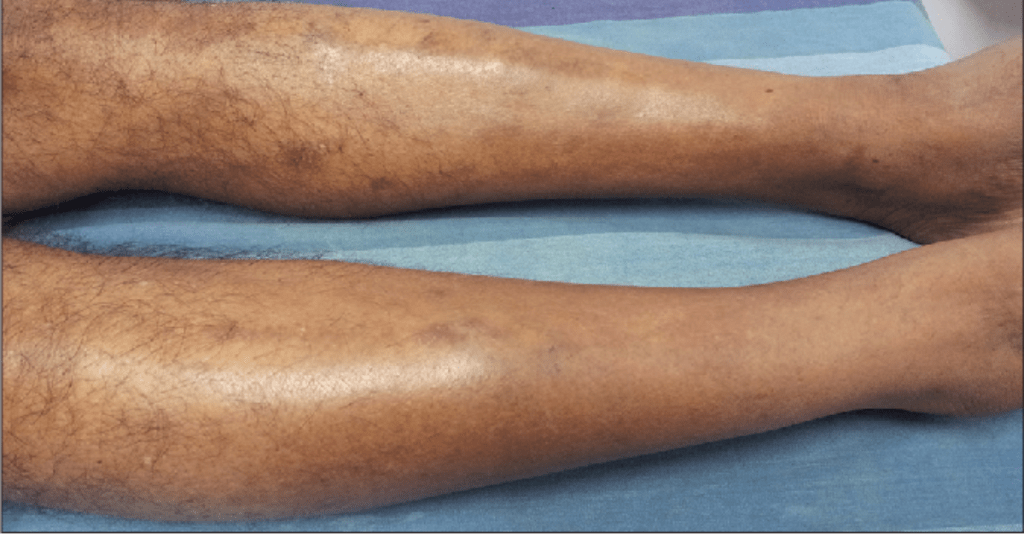 Hair Loss on the Lower Legs