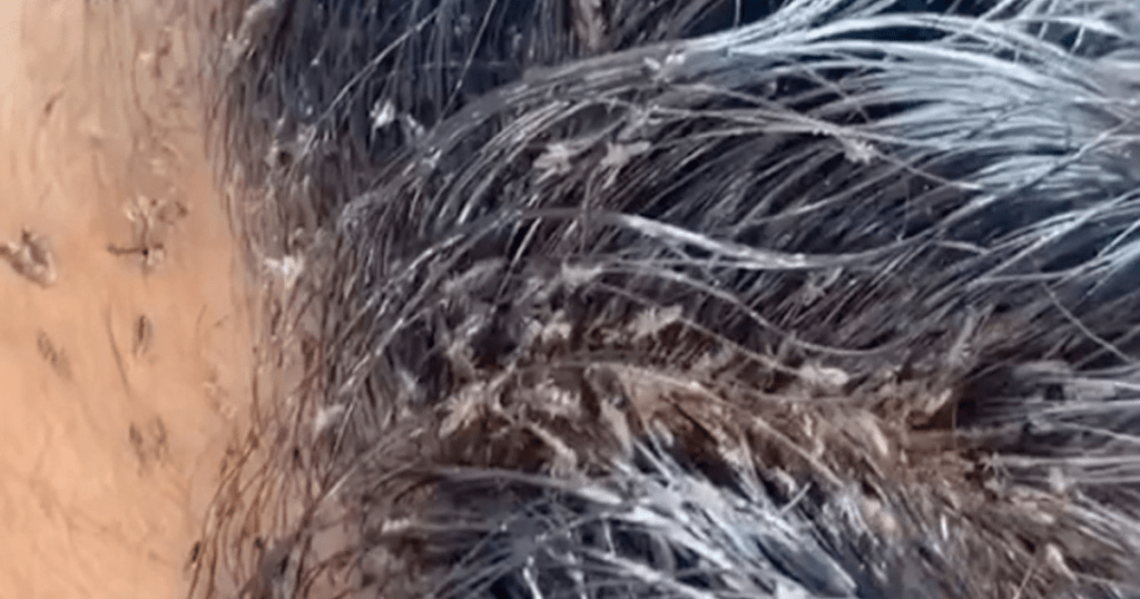 Symptoms of Lice Infestation