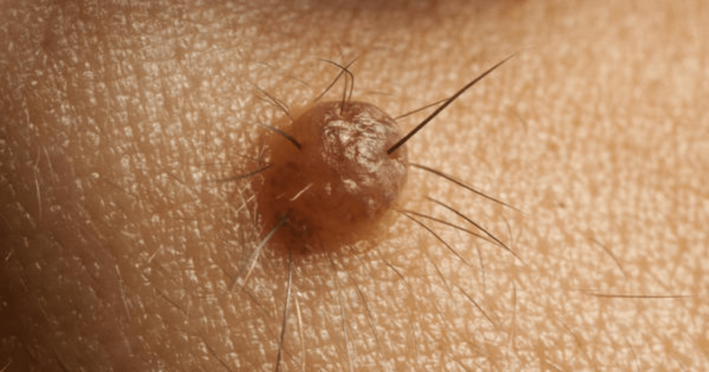 The Connection between Moles and Hair Growth