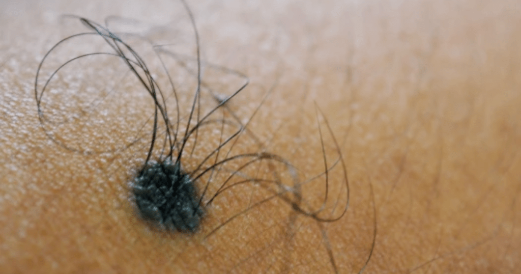 The phenomenon of Hair Growth in Moles