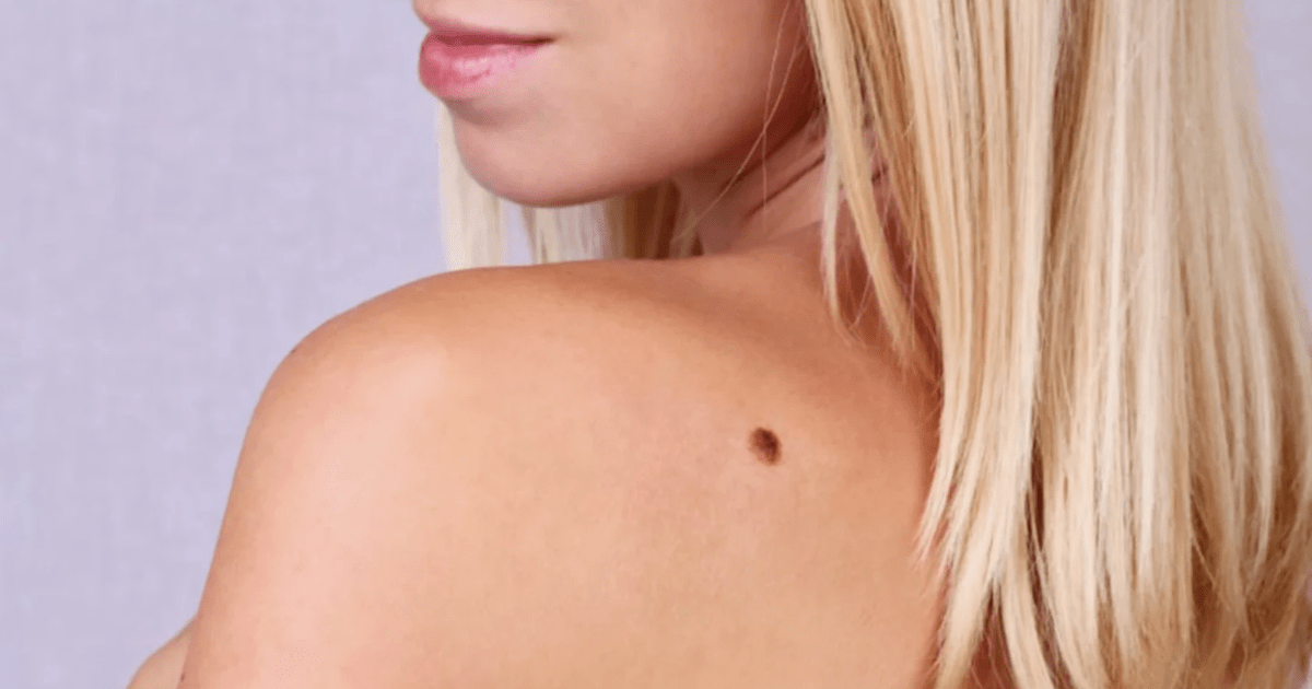 Why Do Hairs Grow From Moles?