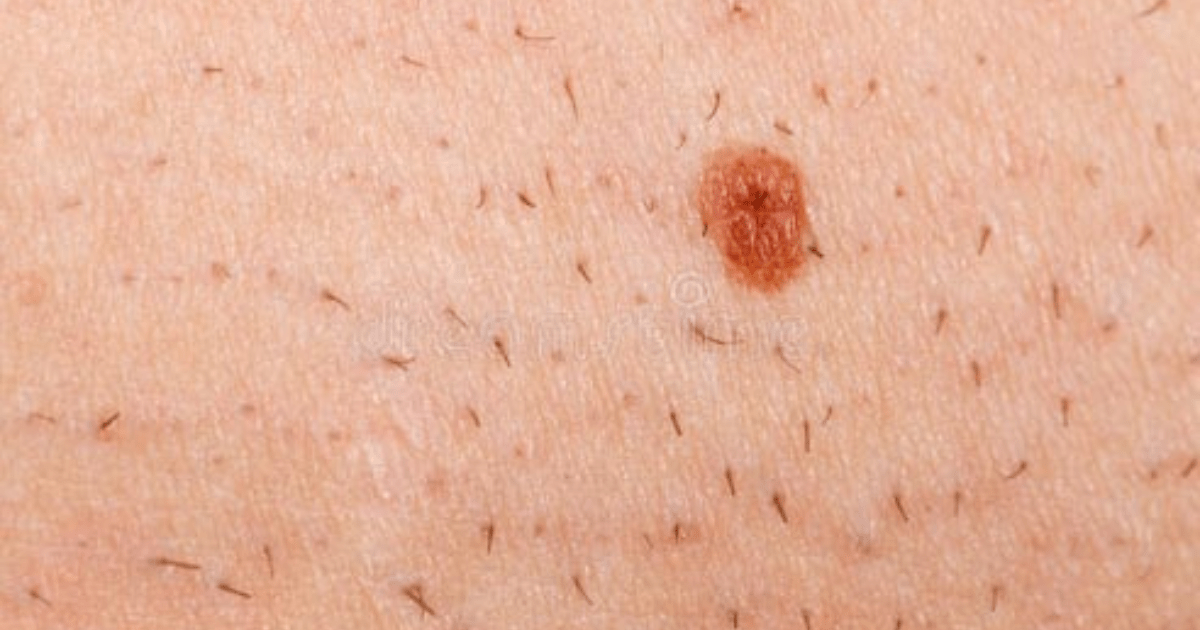 Does Ingrown Hairs Itch?