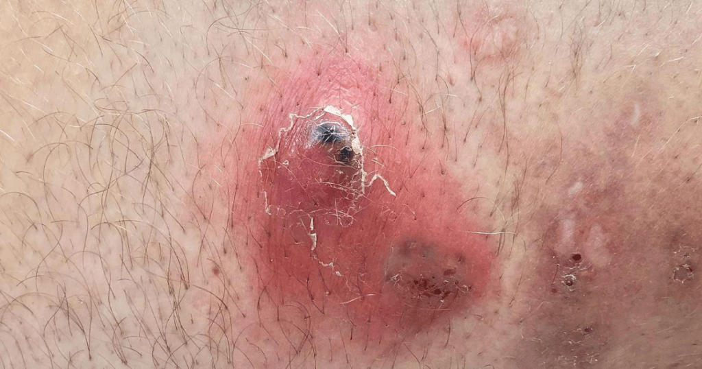 Ingrown Hairs