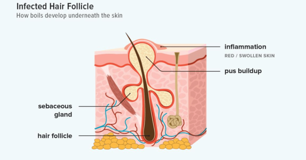 The Causes of Ingrown Hairs