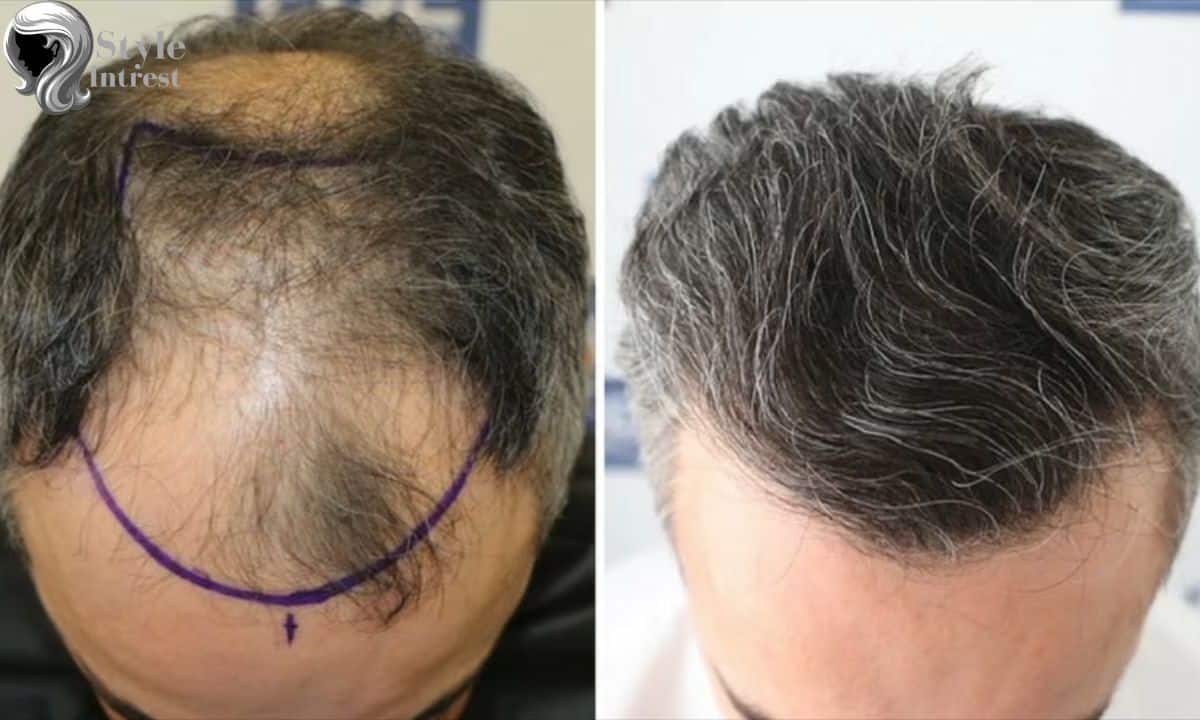 Do You Have to Shave Your Head for Hair Transplant?