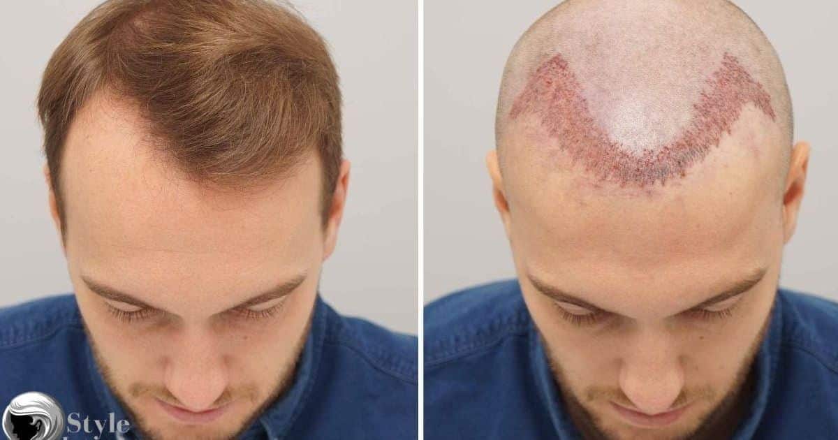 How to Prepare for a Hair Transplant Without Shaving