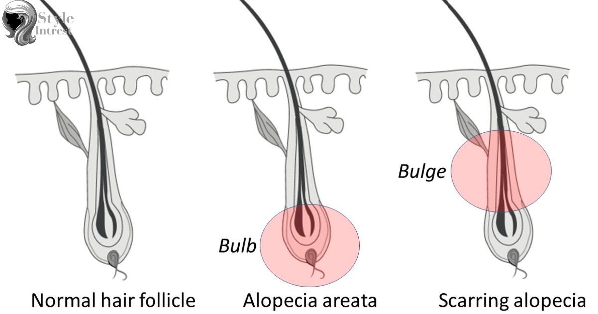 Potential Damage to Hair Follicles