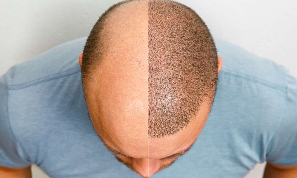 Adjusting Your Sleeping Position After a Hair Transplant