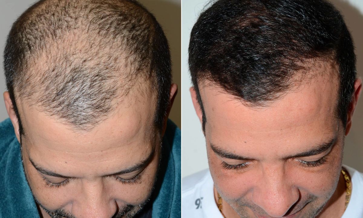 How Many Days After Hair Transplant Can I Sleep Normally?