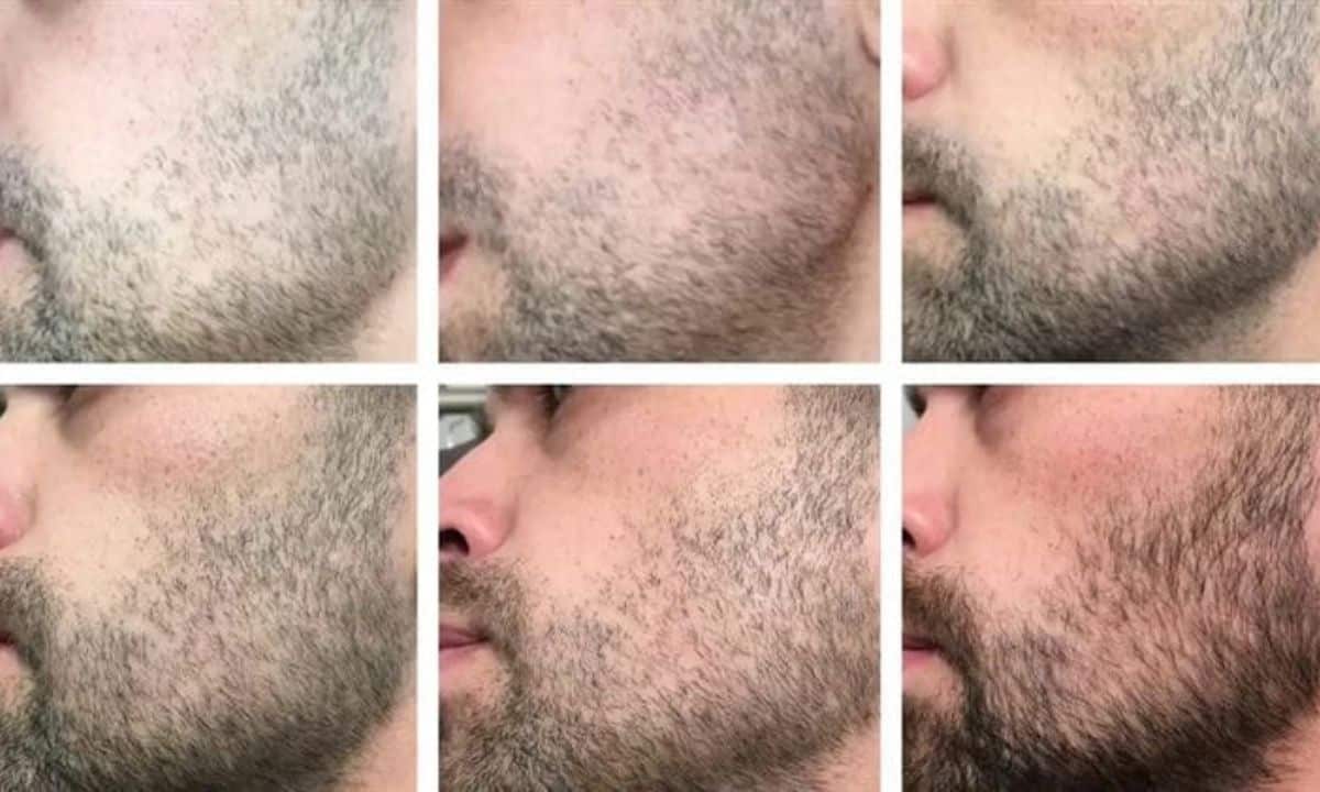 How To Get Rid Of Facial Hair Caused By Minoxidil?