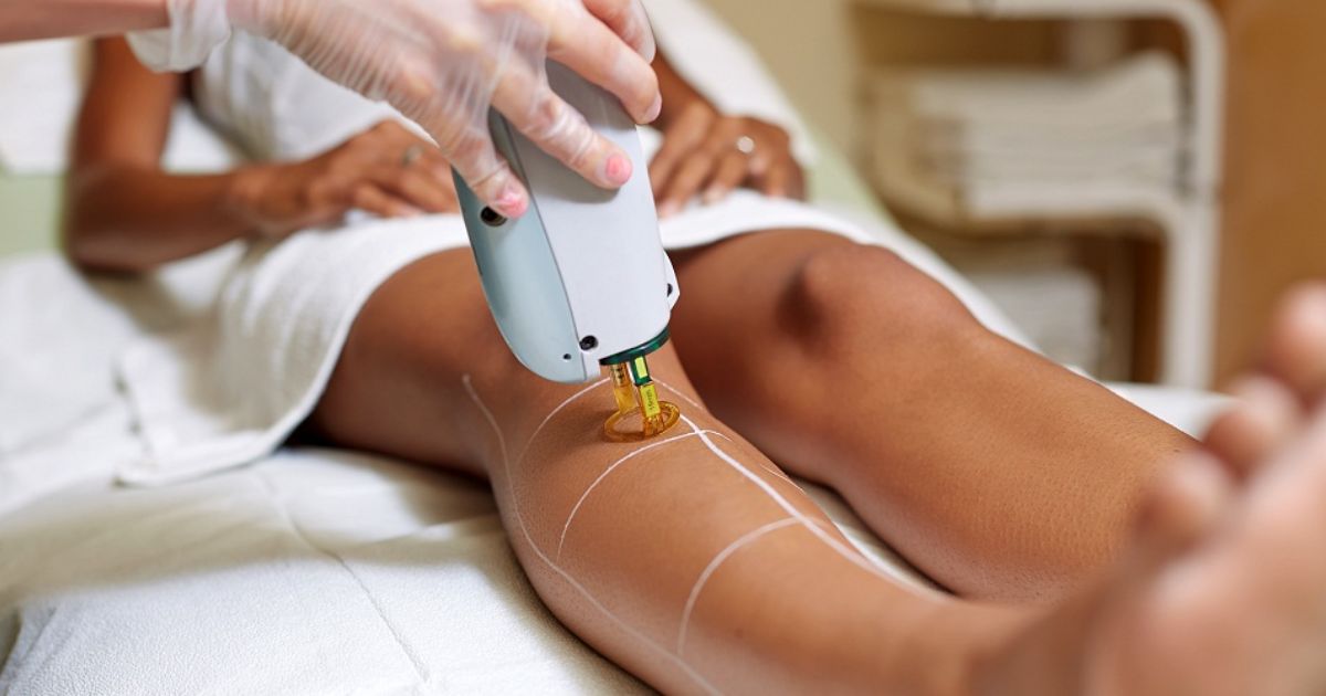 Laser Hair Removal for Dark Skin